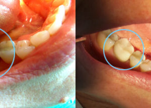 Problem: Large failing amalgam on tooth #30 Procedure: Same day crown on tooth #30