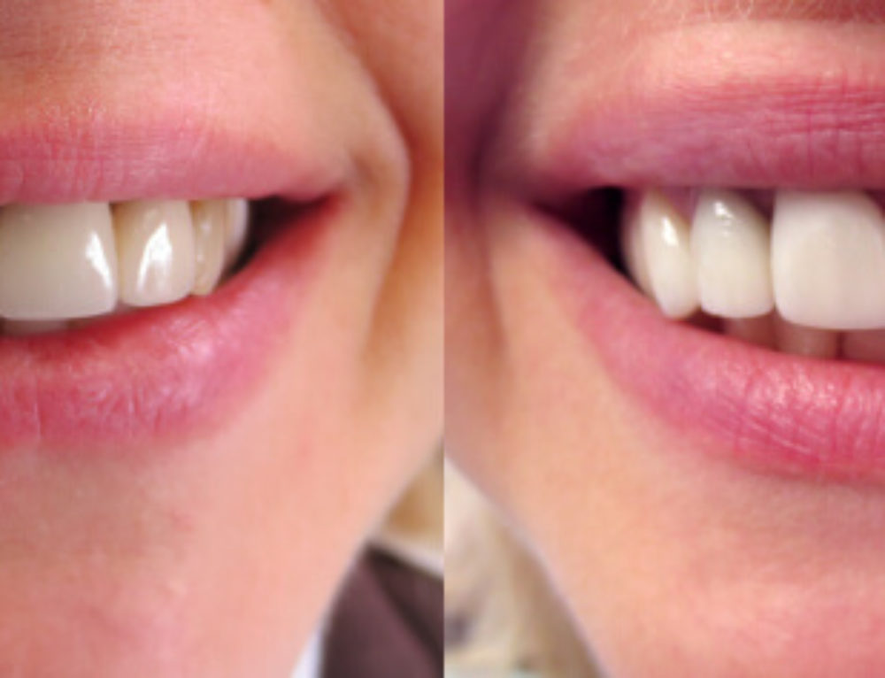 Porcelain veneer Chester Mendham Dental