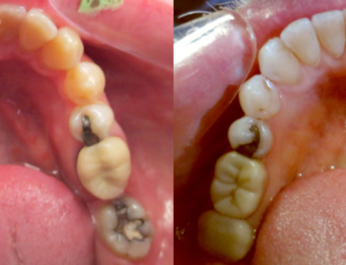 Invisalign – 29 year old female with crowded teeth