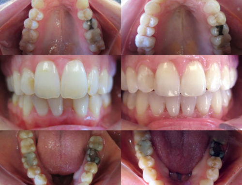 Invisalign – 33 year old female with crowded teeth