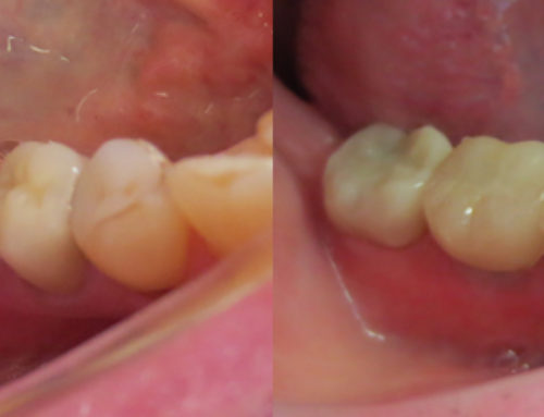 Implant on tooth #30 & crown on #31