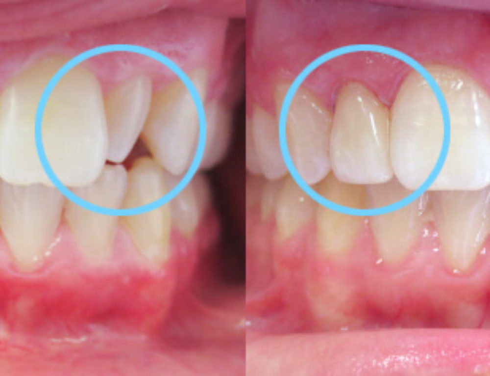 Chairside veneer Chester Mendham Dental