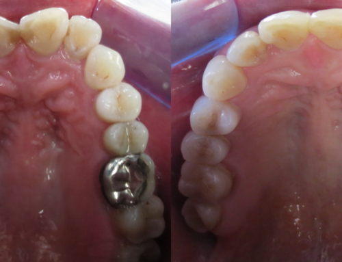 Invisalign – 42 year old female with crowding