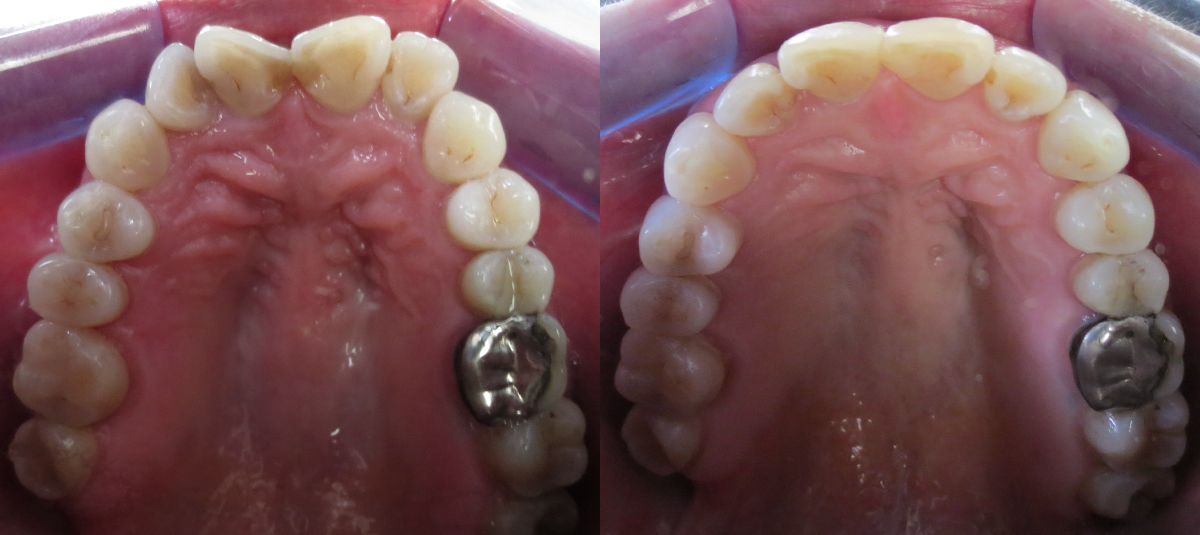 Before and After Invisalign in Chester, NJ