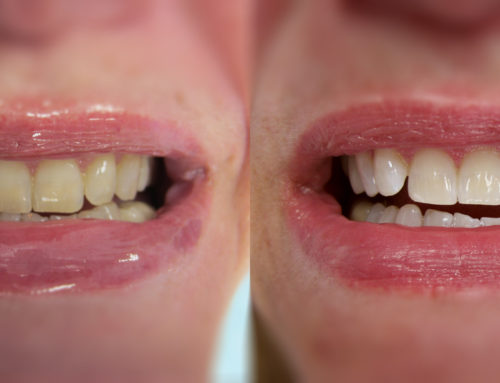Teeth Whitening – April 22nd, 2019