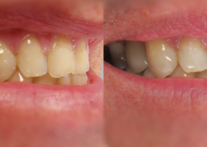 chester-nj-dental-implant