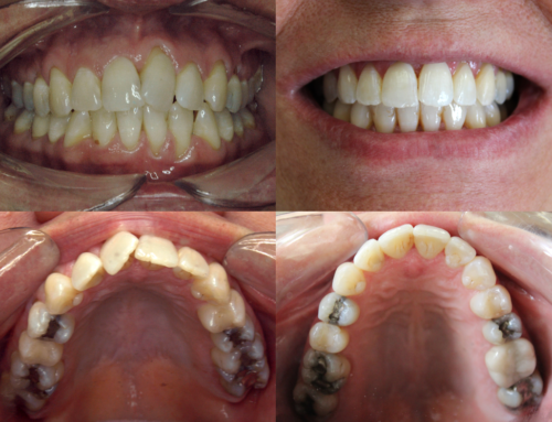 Invisalign – 45 year old female with crowding