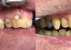 Old fillings with decay and stain replaced with composite
